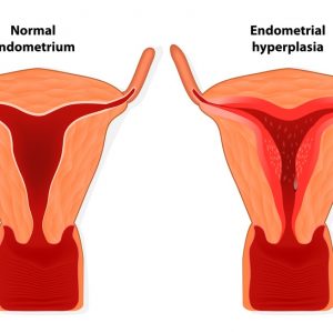 Endometriosis diagram