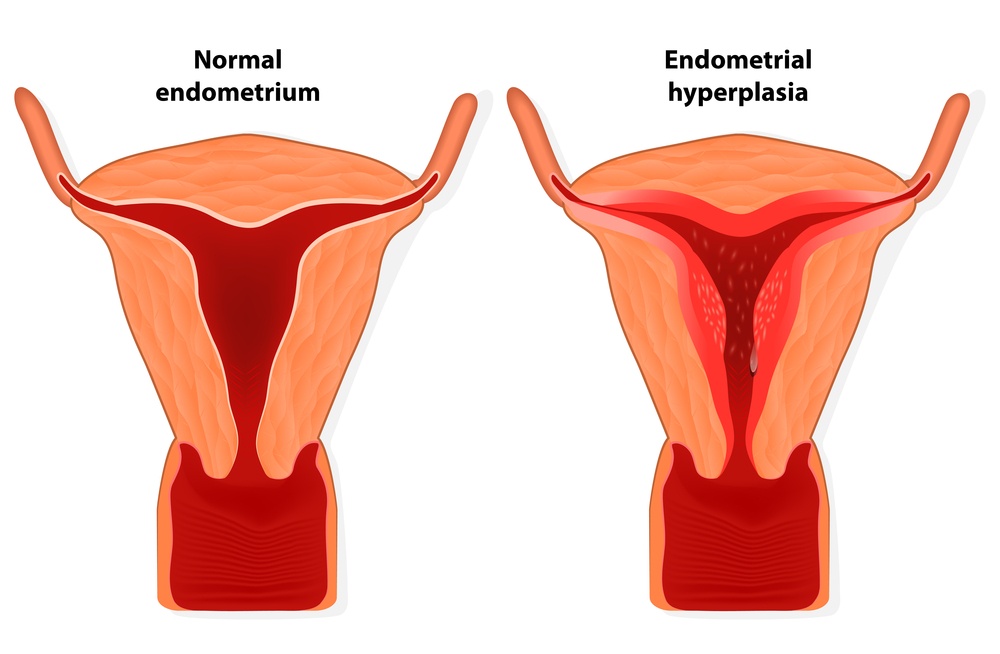 Endometriosis diagram