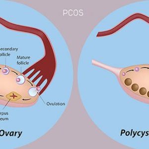 pcos