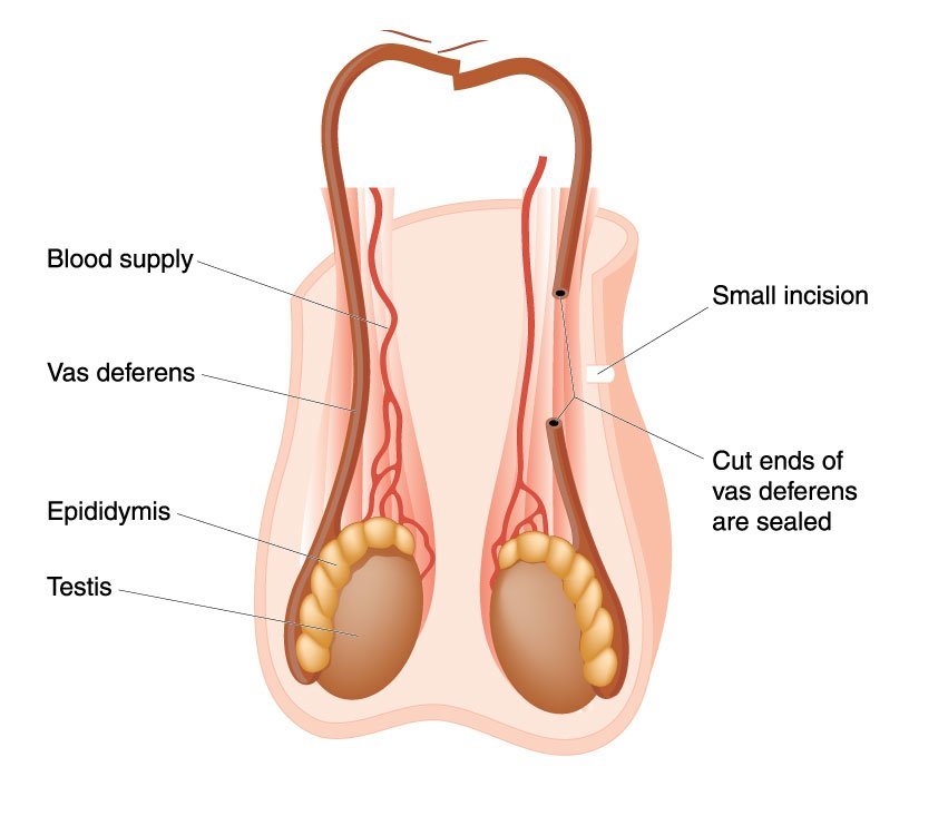 blocked-tubes-and-vasectomies