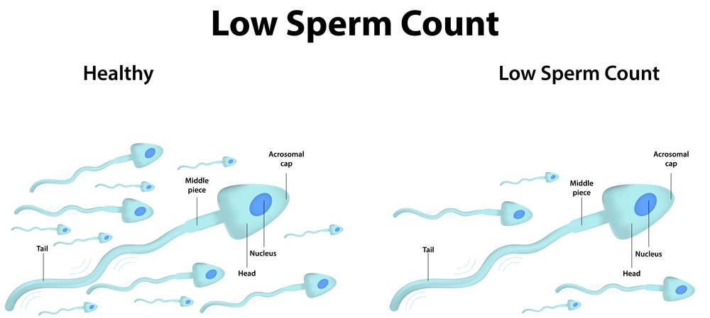 Low Sperm Count Private IVF Wandsworth Concept Fertility