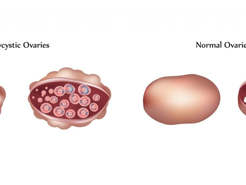 Polycystic ovaries