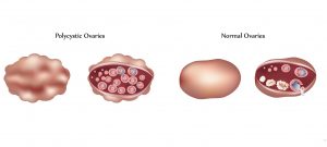 Polycystic ovaries