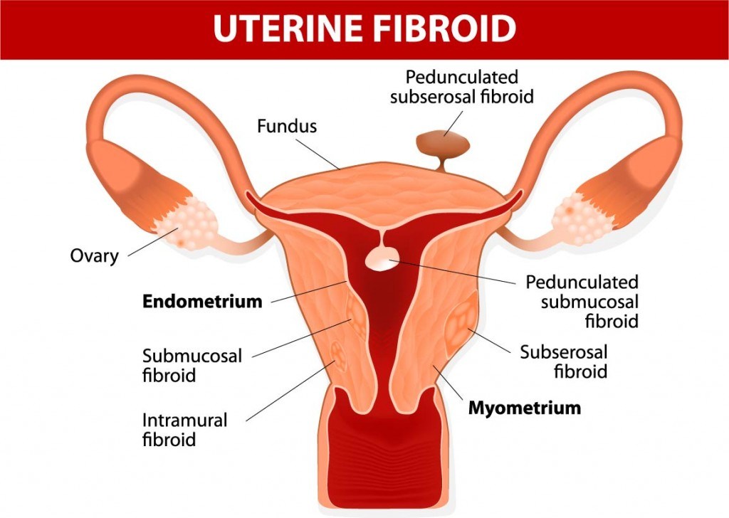 Uterine Fibroids and Fertility - Concept Fertility