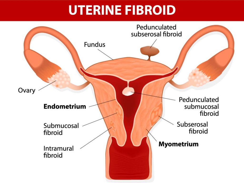 fibroids affecting fertility